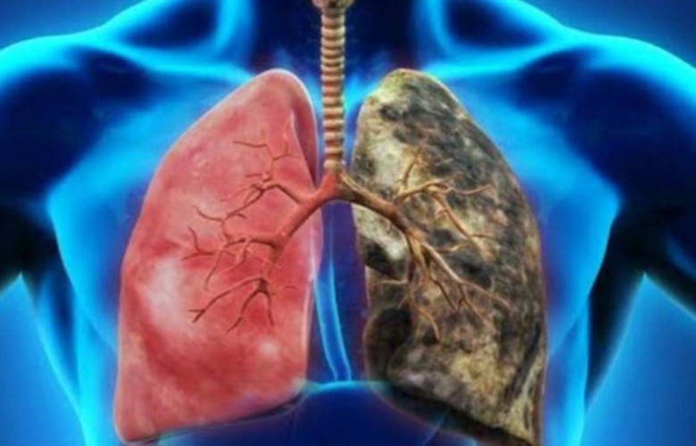 TÜRKİYE’DE 5 MİLYONDAN FAZLA KOAH HASTASI VAR